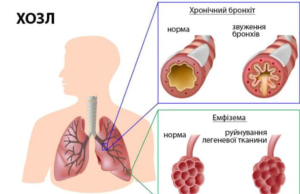 Паліативна допомога при ХОЗЛ